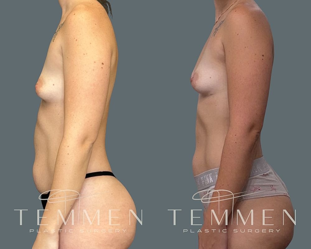 Natural Breast Augmentation Before & After