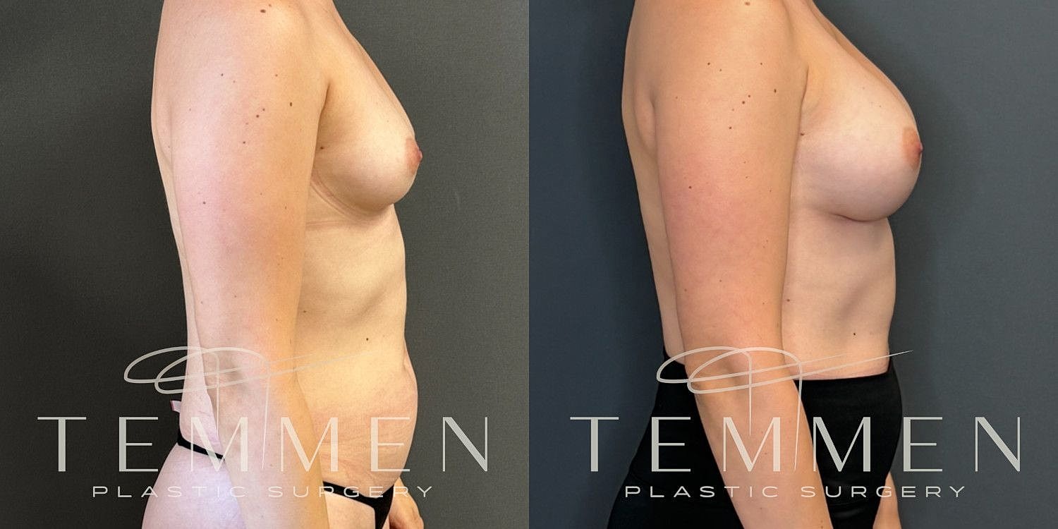 Natural Breast Augmentation Before & After