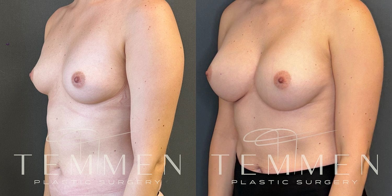Natural Breast Augmentation Before & After