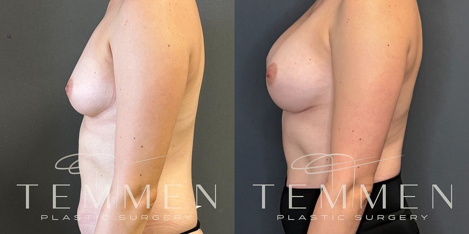 Natural Breast Augmentation Before & After