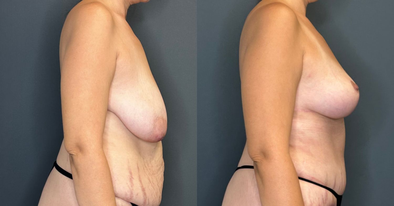 Natural Breast Augmentation Before & After