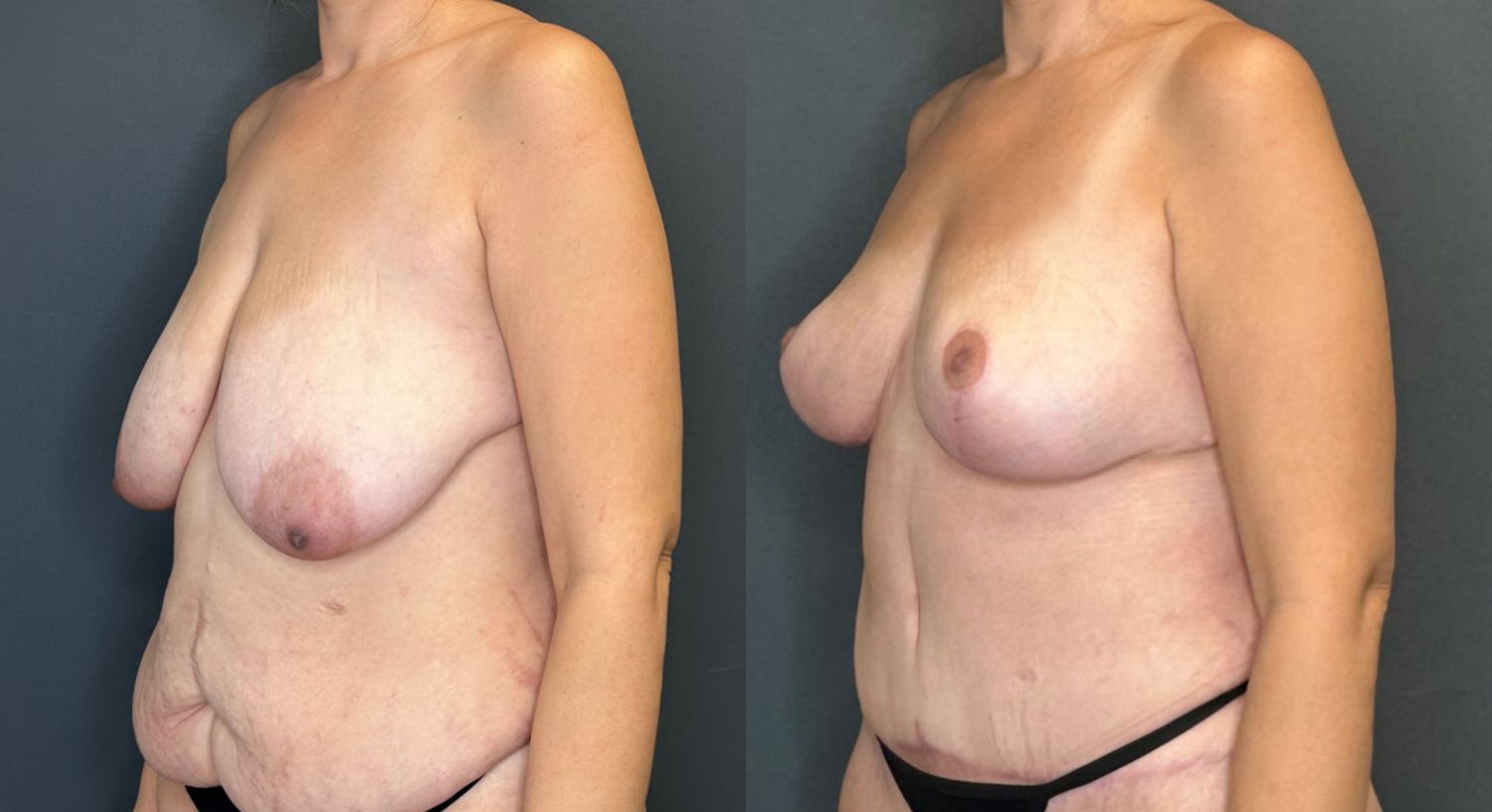 Natural Breast Augmentation Before & After