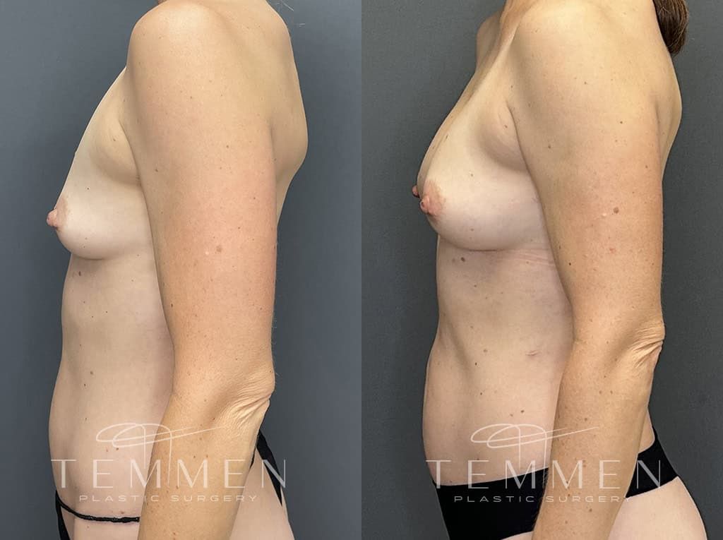 Natural Breast Augmentation Before & After