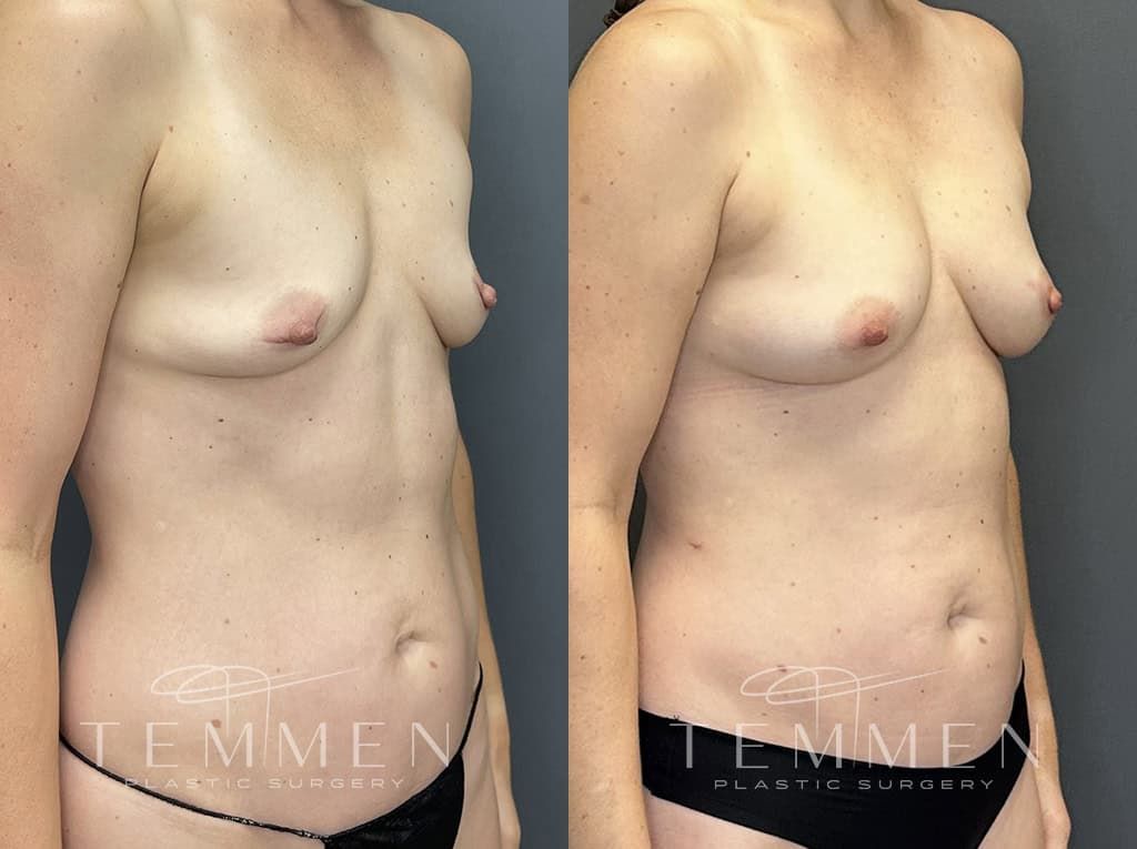Natural Breast Augmentation Before & After