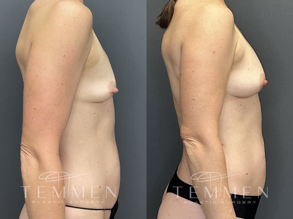 Natural Breast Augmentation Before & After