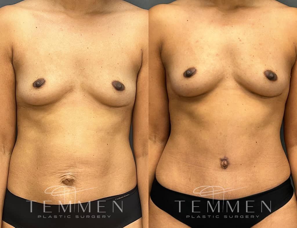 Natural Breast Augmentation Before & After