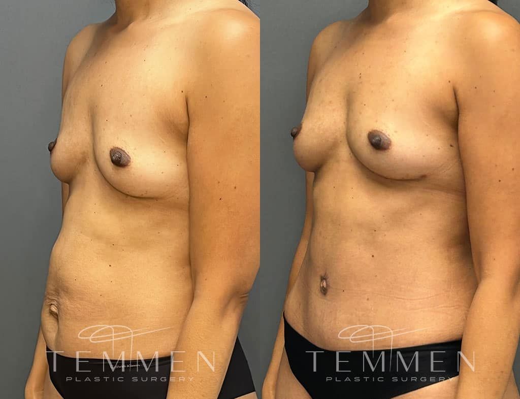 Natural Breast Augmentation Before & After