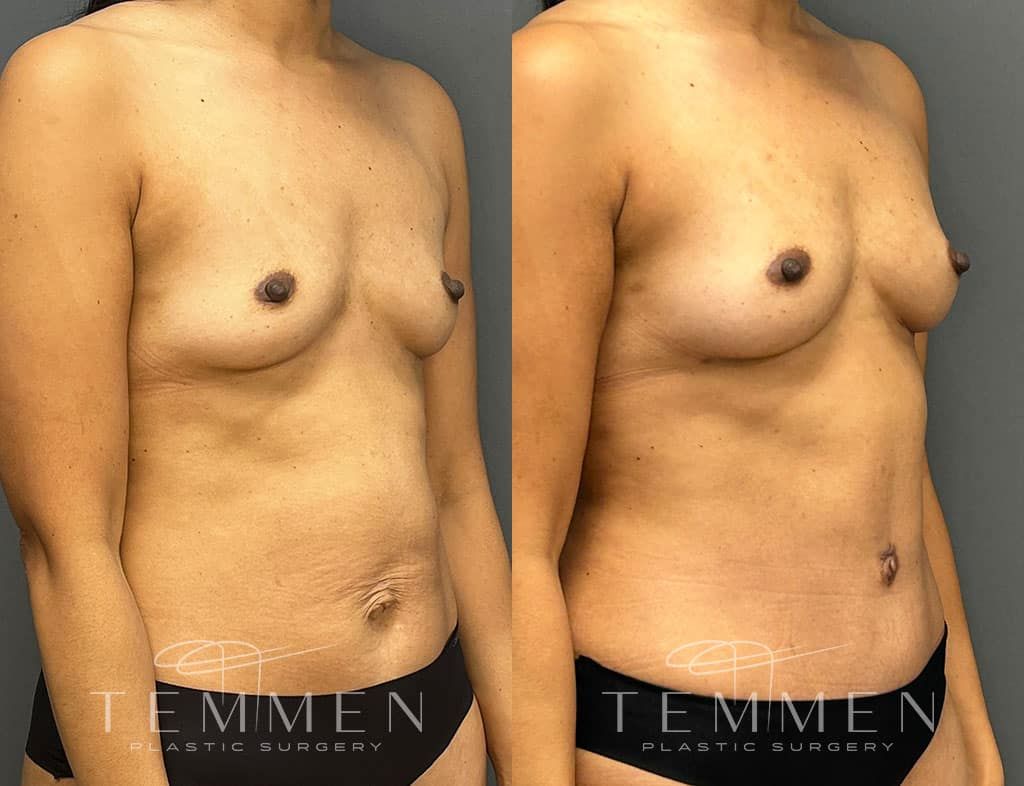 Natural Breast Augmentation Before & After