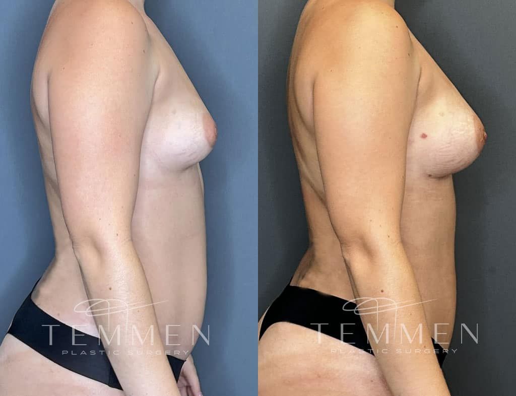 Natural Breast Augmentation Before & After
