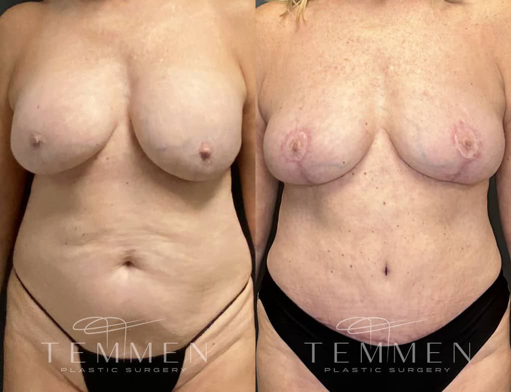 Breast Implant Removal Breast Lift Liposuction Fat Transfer To The Breasts And Tummy Tuck Before & After