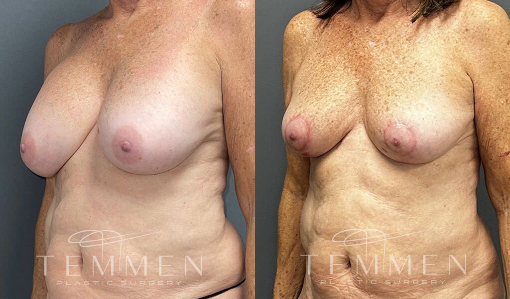 Breast Implant Removal Breast Lift Liposuction Fat Transfer To The Breasts And Tummy Tuck Before & After