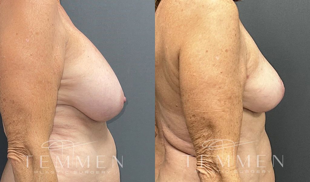 Breast Implant Removal Breast Lift Liposuction Fat Transfer To The Breasts And Tummy Tuck Before & After