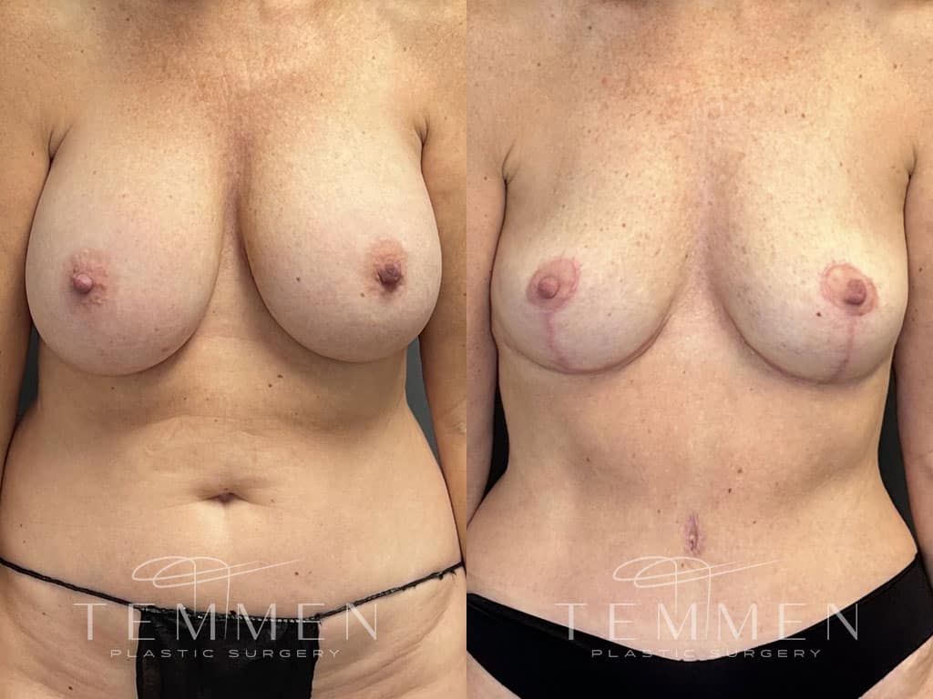 Breast Implant Removal Breast Lift Liposuction Fat Transfer To The Breasts And Tummy Tuck Before & After