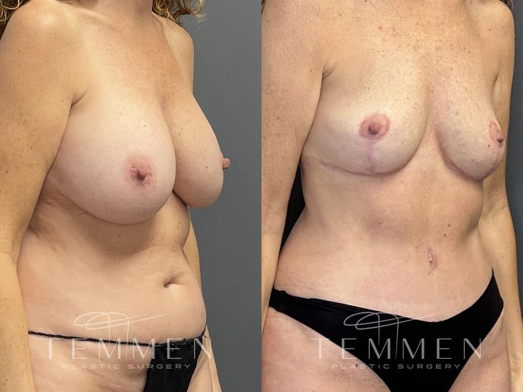 Breast Implant Removal Breast Lift Liposuction Fat Transfer To The Breasts And Tummy Tuck Before & After