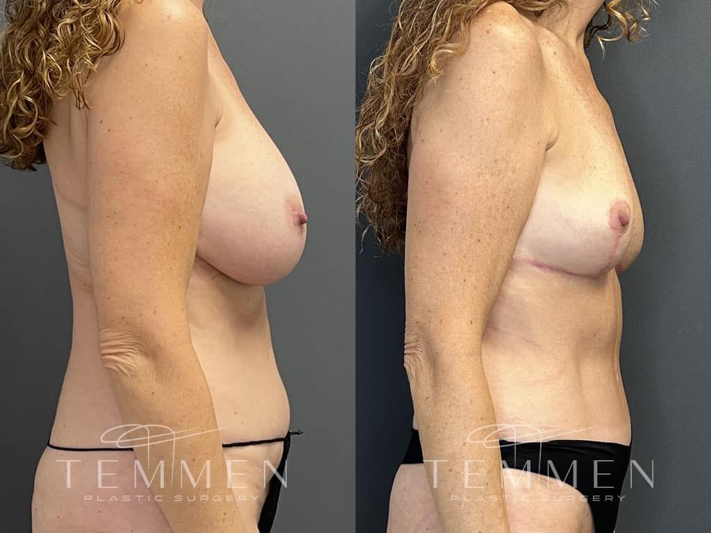 Breast Implant Removal Breast Lift Liposuction Fat Transfer To The Breasts And Tummy Tuck Before & After