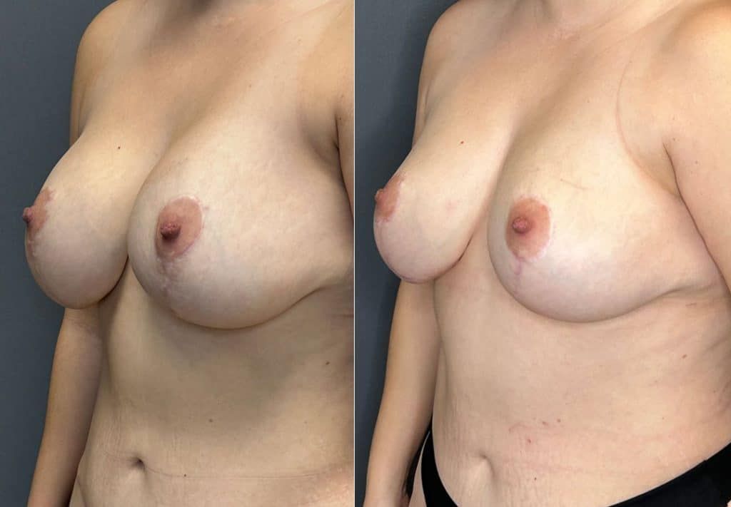 Breast Implant Removal Breast Lift Liposuction Fat Transfer To The Breasts And Tummy Tuck Before & After