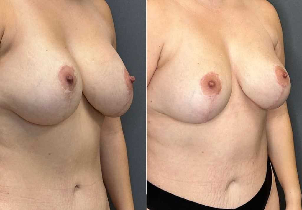 Breast Implant Removal Breast Lift Liposuction Fat Transfer To The Breasts And Tummy Tuck Before & After