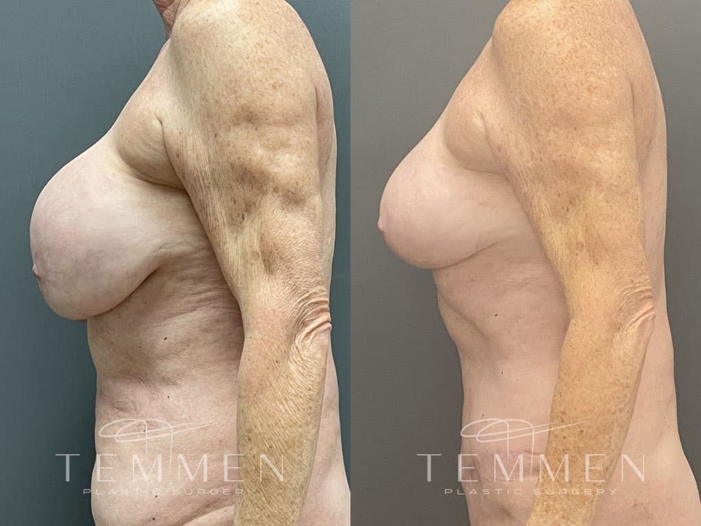 Breast Implant Removal Breast Lift Liposuction Fat Transfer To The Breasts And Tummy Tuck Before & After