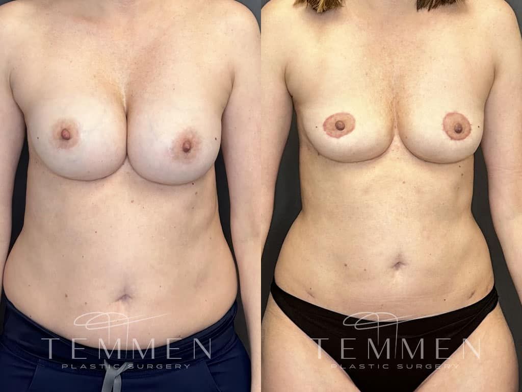 Breast Implant Removal Breast Lift Liposuction Fat Transfer To The Breasts And Tummy Tuck Before & After