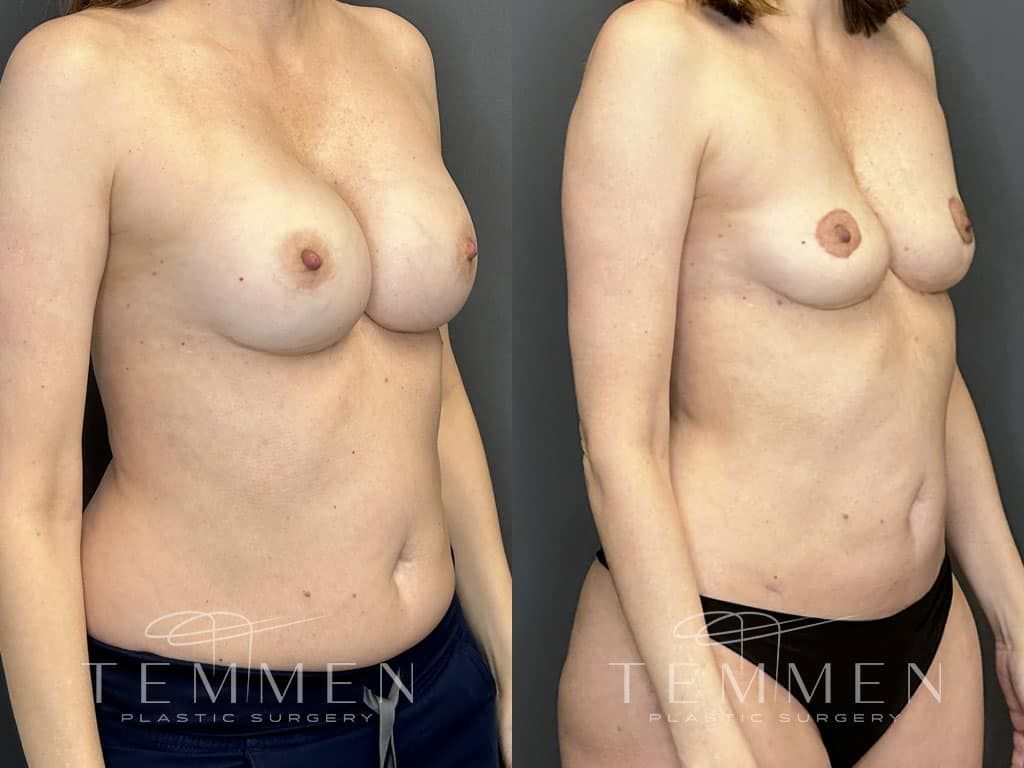 Breast Implant Removal Breast Lift Liposuction Fat Transfer To The Breasts And Tummy Tuck Before & After