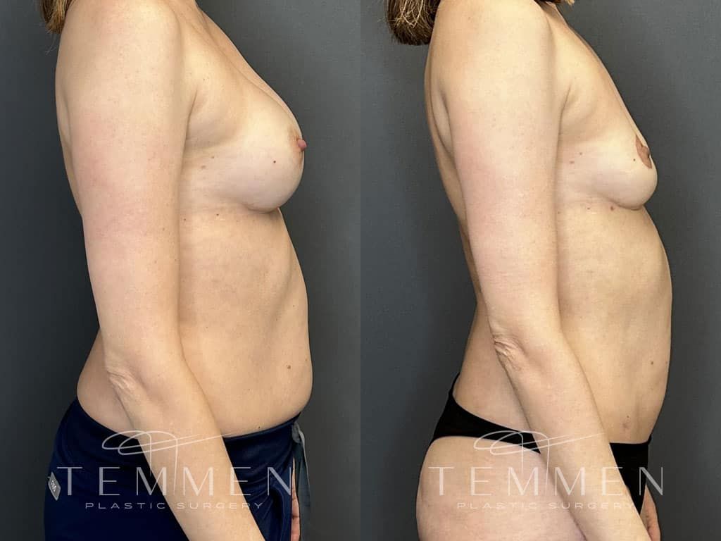 Breast Implant Removal Breast Lift Liposuction Fat Transfer To The Breasts And Tummy Tuck Before & After