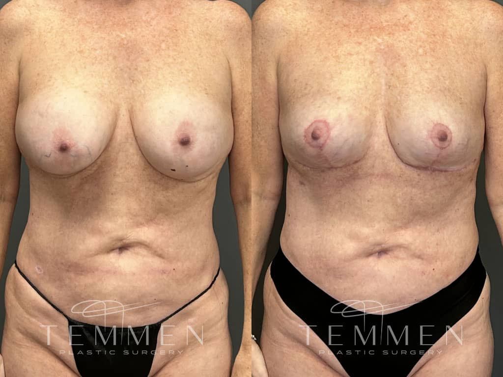 Breast Implant Removal Breast Lift Liposuction Fat Transfer To The Breasts And Tummy Tuck Before & After