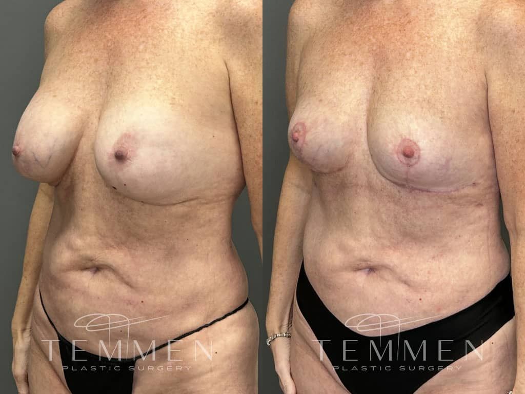 Breast Implant Removal Breast Lift Liposuction Fat Transfer To The Breasts And Tummy Tuck Before & After