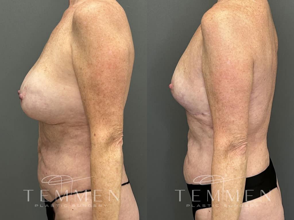 Breast Implant Removal Breast Lift Liposuction Fat Transfer To The Breasts And Tummy Tuck Before & After