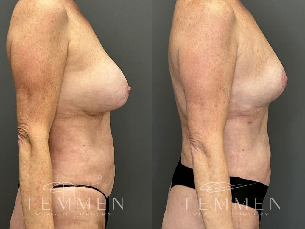 Breast Implant Removal Breast Lift Liposuction Fat Transfer To The Breasts And Tummy Tuck Before & After
