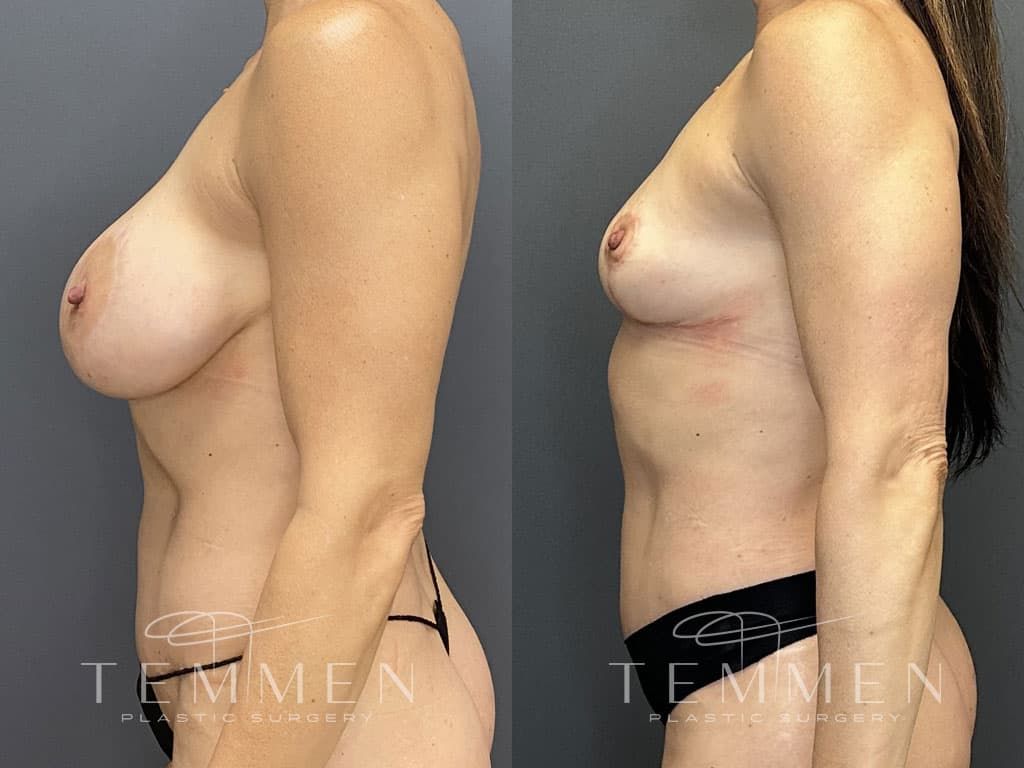Breast Implant Removal Breast Lift Liposuction Fat Transfer To The Breasts And Tummy Tuck Before & After