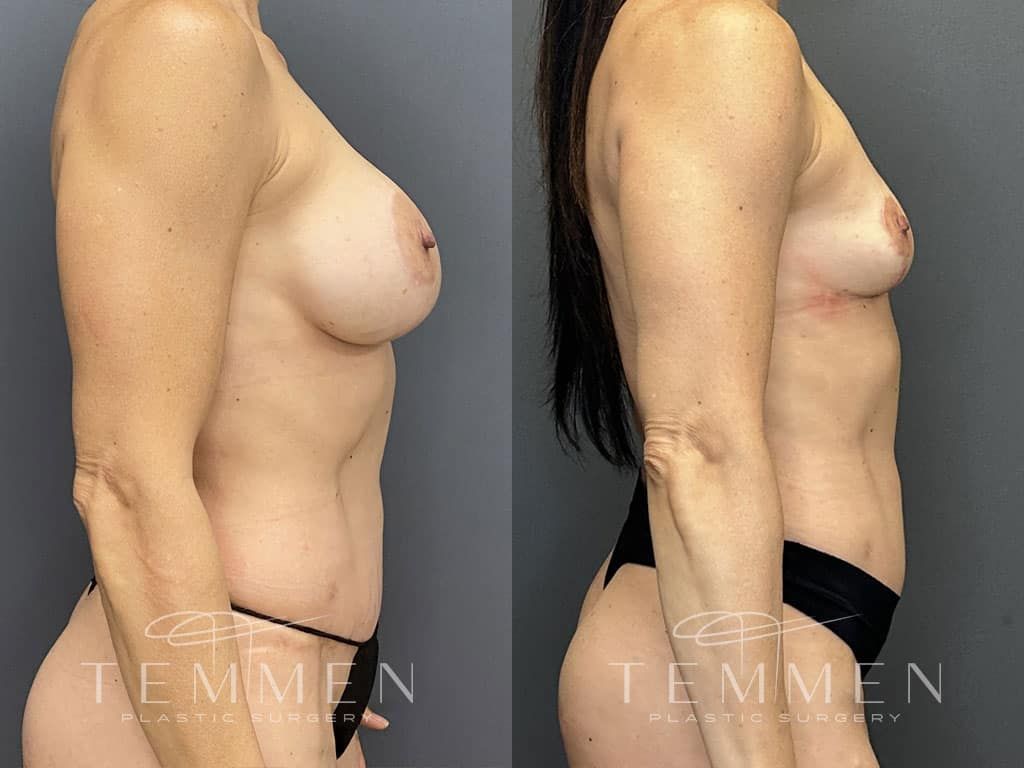 Breast Implant Removal Breast Lift Liposuction Fat Transfer To The Breasts And Tummy Tuck Before & After