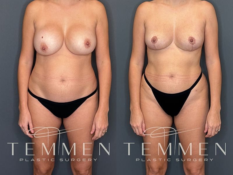Implant Removal, Lift, & Fat Transfer Before & After