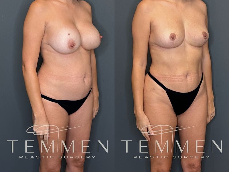 Implant Removal, Lift, & Fat Transfer Before & After