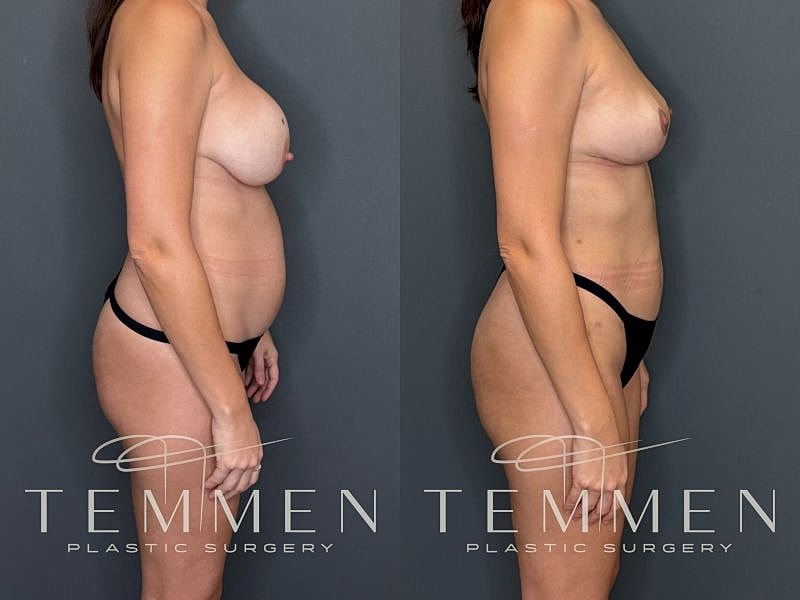 Implant Removal, Lift, & Fat Transfer Before & After