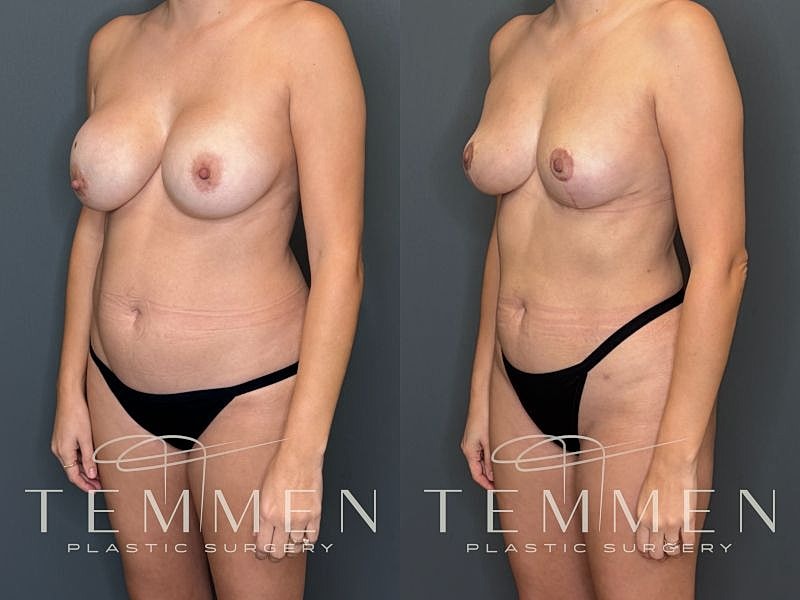 Implant Removal, Lift, & Fat Transfer Before & After
