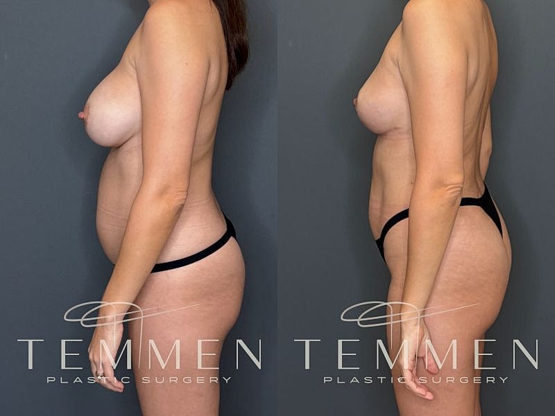 Implant Removal, Lift, & Fat Transfer Before & After