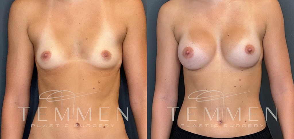 Small Breast Augmentation Before & After