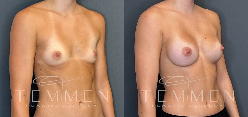 Small Breast Augmentation Before & After