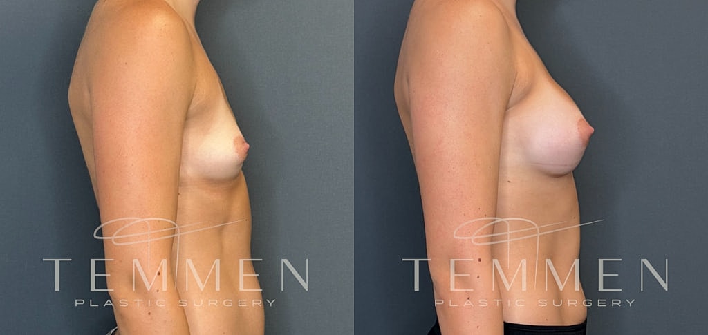 Small Breast Augmentation Before & After