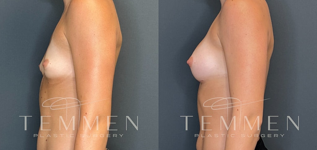 Small Breast Augmentation Before & After