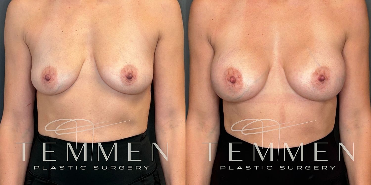 Small Breast Augmentation Before & After