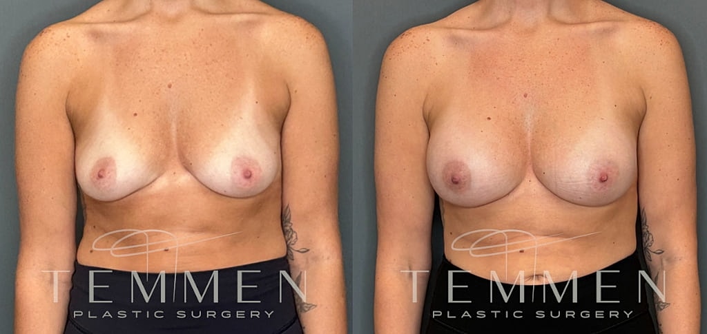 Small Breast Augmentation Before & After