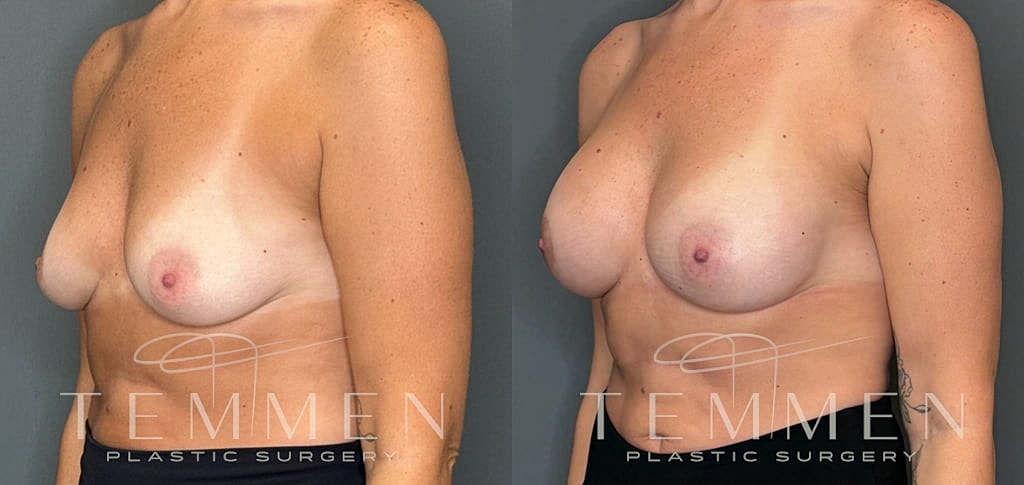 Small Breast Augmentation Before & After