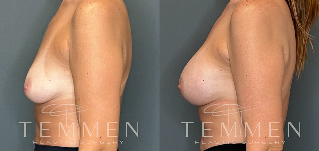 Small Breast Augmentation Before & After