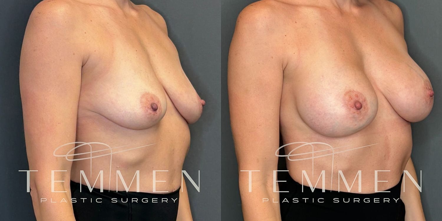 Small Breast Augmentation Before & After