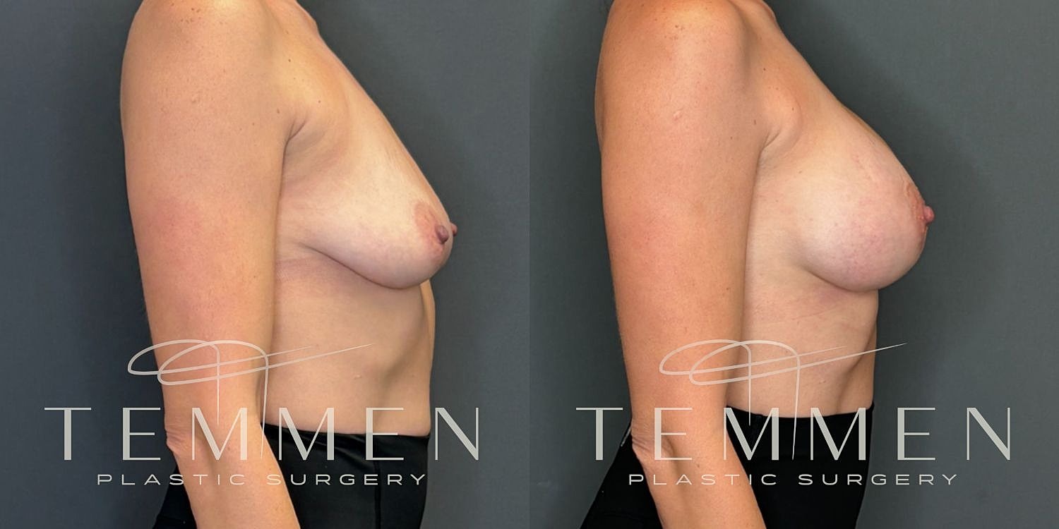 Small Breast Augmentation Before & After