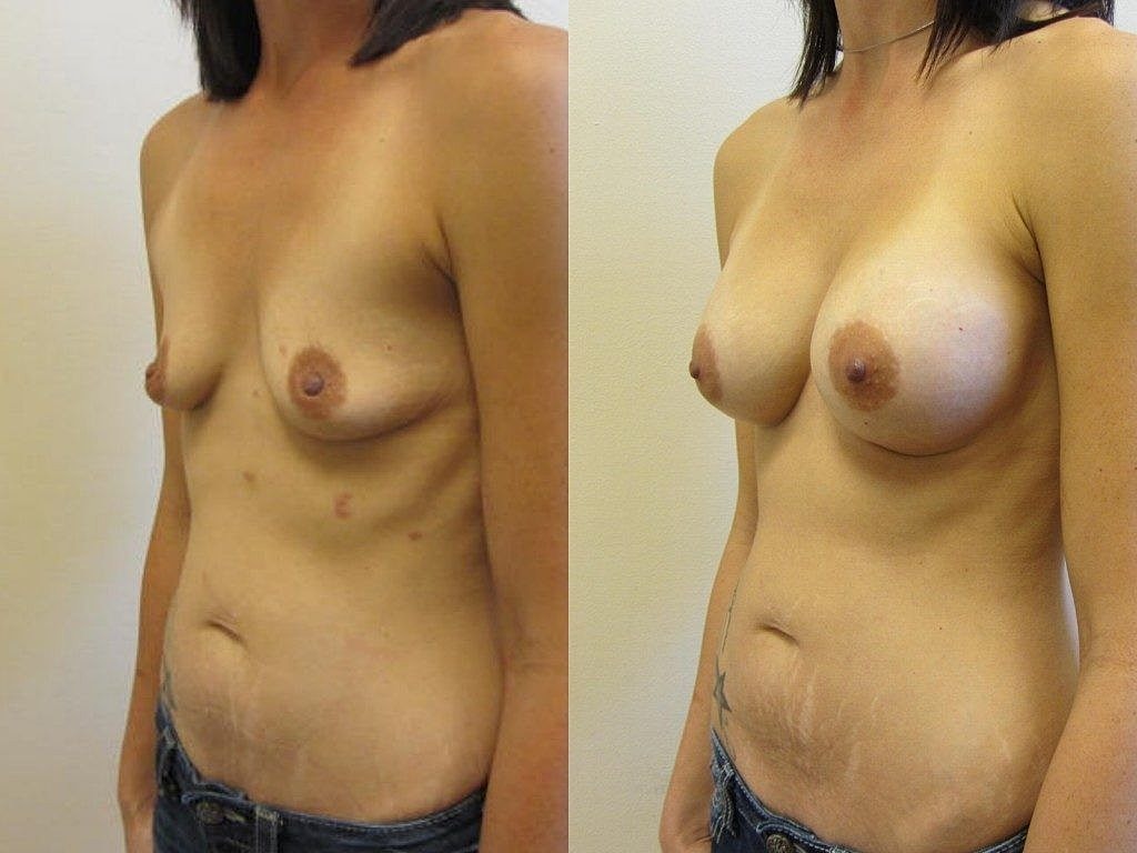Before and after body contouring transformation.