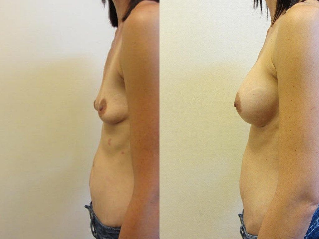 Before and after breast enhancement comparison image