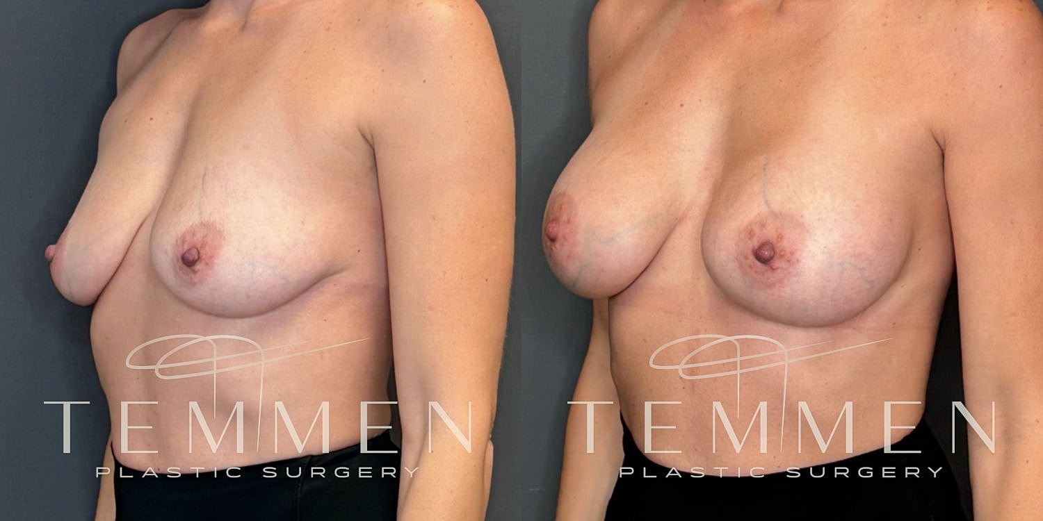 Small Breast Augmentation Before & After