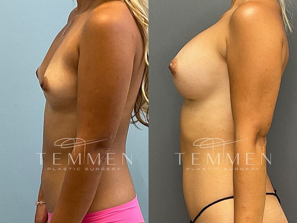 Before and after breast augmentation comparison photo